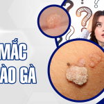 Thắc mắc về sùi mào gà