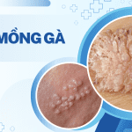 BỆNH MỒNG GÀ
