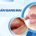 CHẨN ĐOÁN BỆNH GIANG MAI