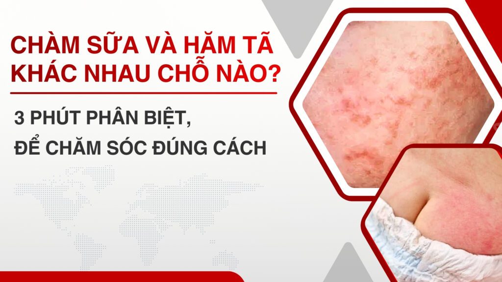 Chàm sữa và Hăm tã khác nhau chỗ nào? 3 phút phân biệt để chăm sóc đúng cách