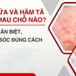 Chàm sữa và Hăm tã khác nhau chỗ nào? 3 phút phân biệt để chăm sóc đúng cách