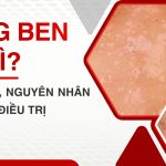 Lang ben là gì? Dấu hiệu, nguyên nhân và cách điều trị