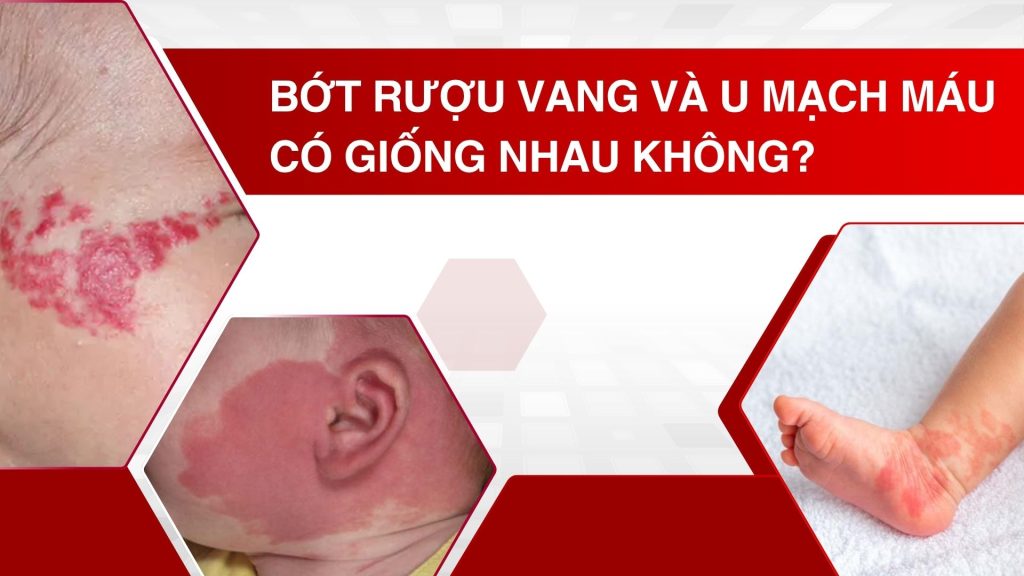 Bớt rượu vang và U mạch máu có giống nhau không? Cách phân biệt và điều trị hiệu quả tại Medcare