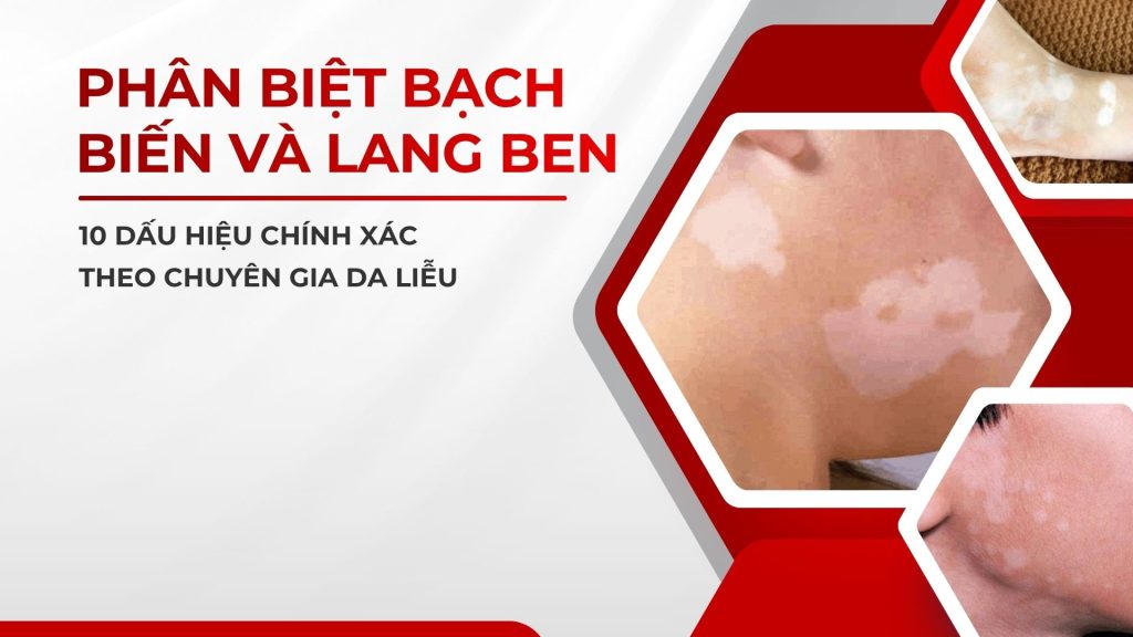 Phân Biệt Bạch Biến Và Lang Ben: 10 Dấu Hiệu Chính Xác Theo Chuyên Gia Da Liễu