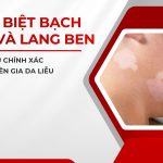 Phân Biệt Bạch Biến Và Lang Ben: 10 Dấu Hiệu Chính Xác Theo Chuyên Gia Da Liễu