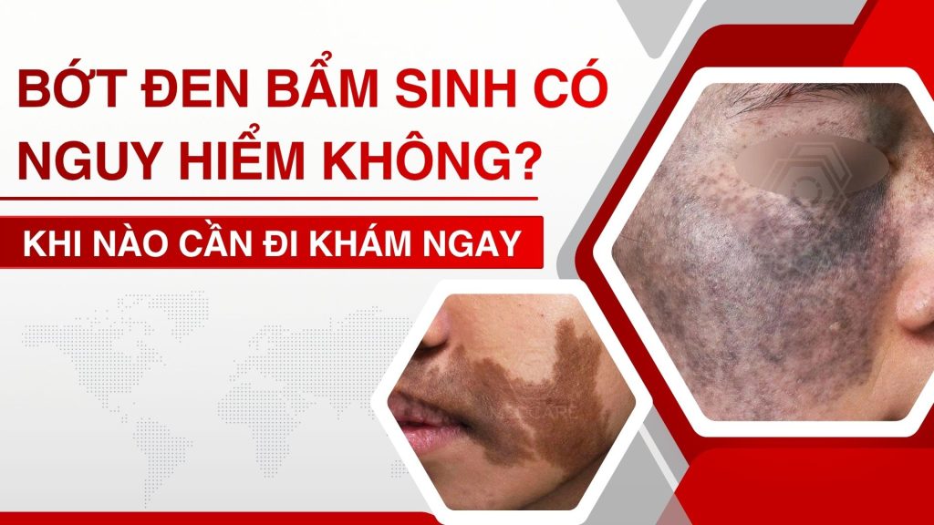 Bớt đen bẩm sinh có nguy hiểm không? Khi nào cần đi khám ngay