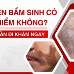 Bớt đen bẩm sinh có nguy hiểm không? Khi nào cần đi khám ngay