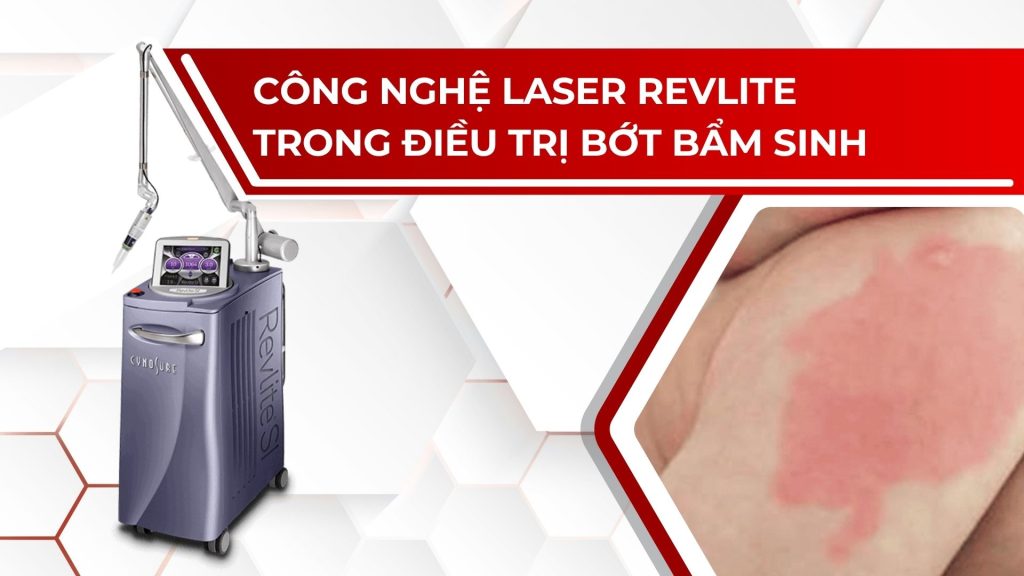 Công nghệ laser Revlite trong điều trị bớt bẩm sinh
