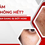 Trị nám mãi không hết? Có thể bạn đang bị bớt Hori