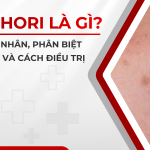 Bớt Hori là gì? Nguyên nhân, phân biệt với nám và cách điều trị